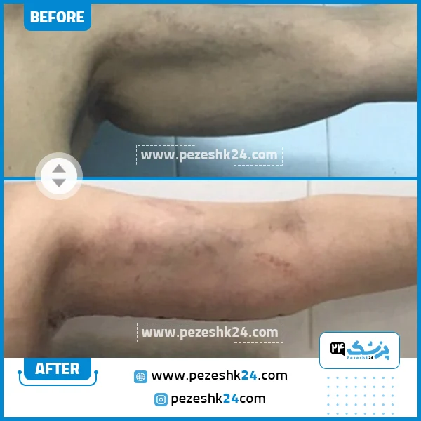 قبل و بعد لیپوماتیک دکتر زارع