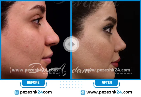 عکس قبل و بعد عمل بینی استخوانی دکتر جاودانی