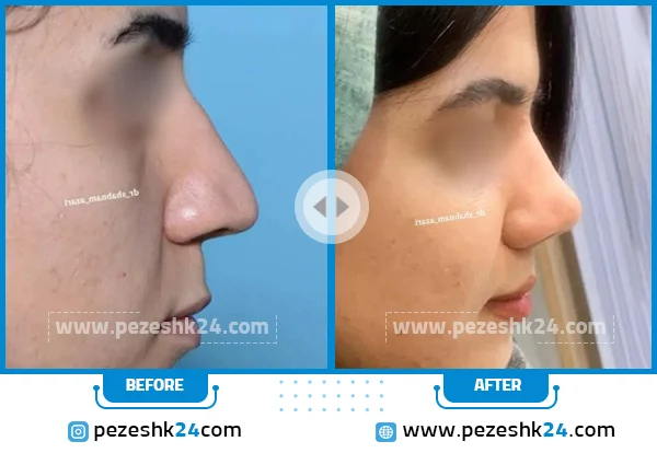 قبل و بعد عمل بینی استخوانی دکتر شبنم آذری