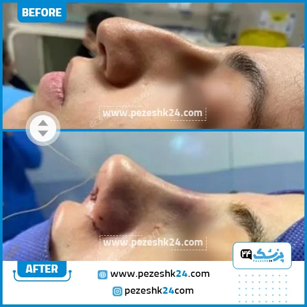 قبل و بعد جراحی بینی غضروفی دکتر آذری