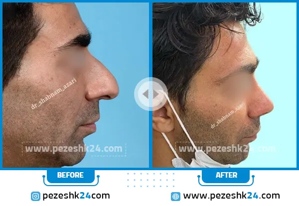 قبل و بعد عمل بینی غضروفی دکتر آذری
