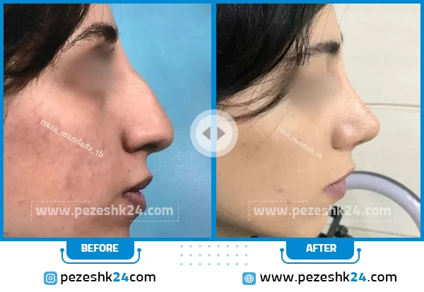 قبل و بعد عمل بینی غضروفی دکتر آذری اصفهان