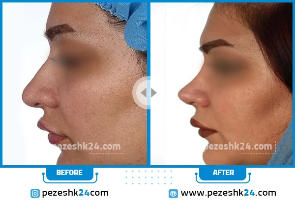 قبل و بعد جراحی بینی دکتر حجاری