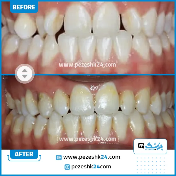 قبل و بعد ارتودنسی دندان دکتر احسان شاه ولی