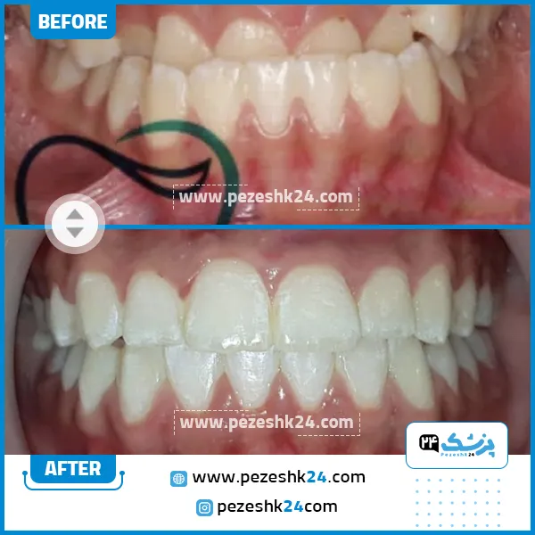قبل و بعد ارتودنسی دندان دکتر شاه ولی