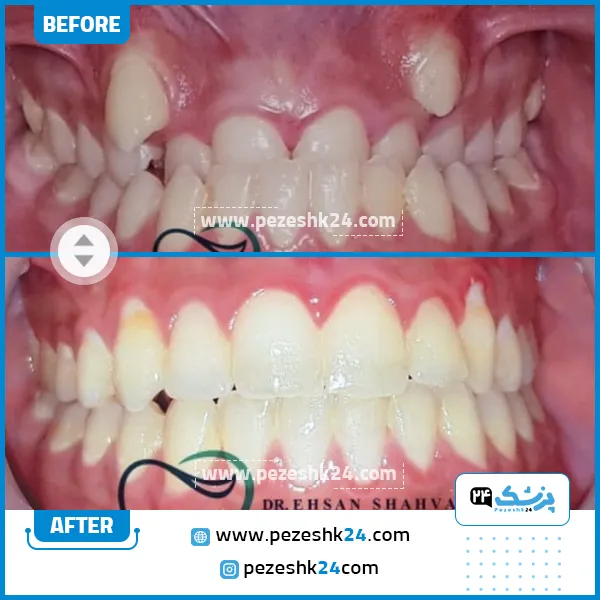 قبل و بعد ارتودنسی دکتر شاه ولی