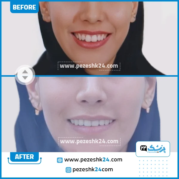 قبل و ارتودنسی دندان دکتر باصفا