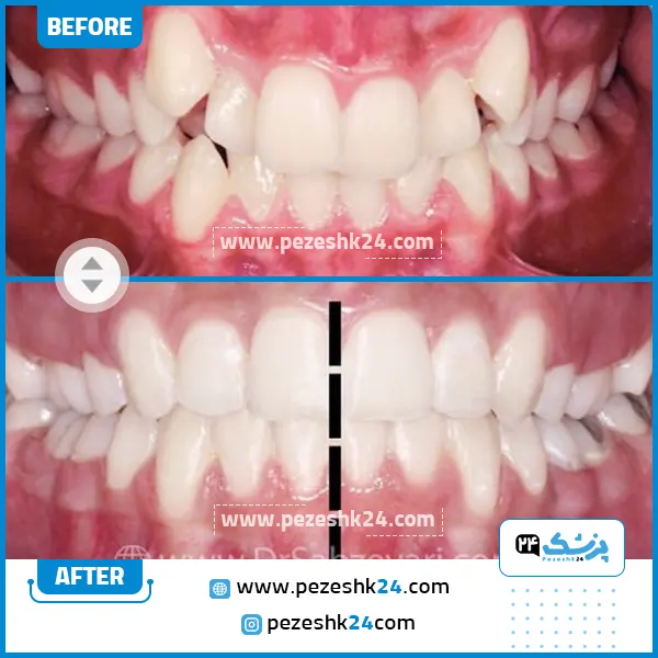 قبل و بعد ارتودنسی دندان دکتر سبزواری مشهد
