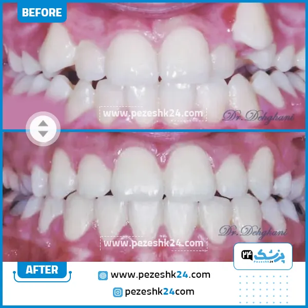 قبل و بعد ارتودنسی دندان دکتر دهقانی
