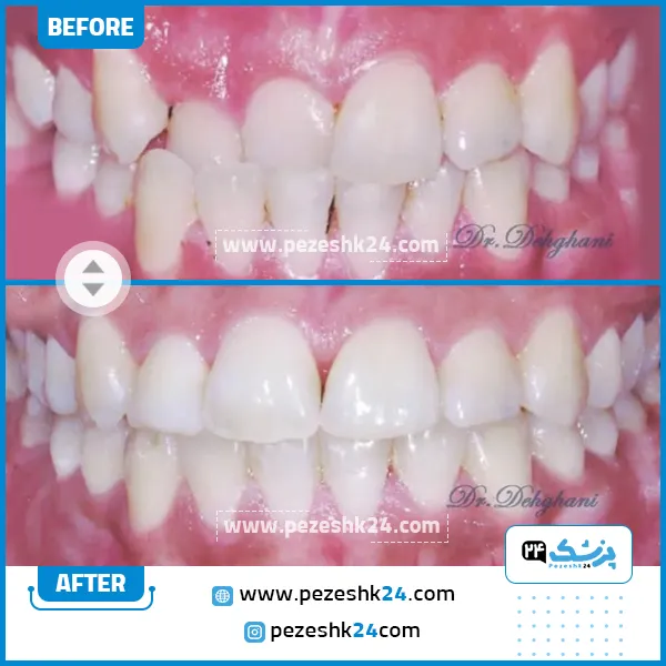 قبل و بعد ارتودنسی دکتر دهقانی