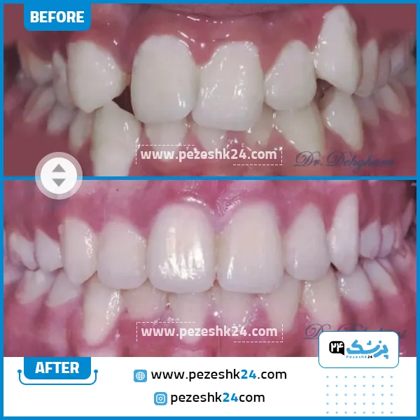قبل و بعد ارتودنسی دکتر دهقانی مشهد