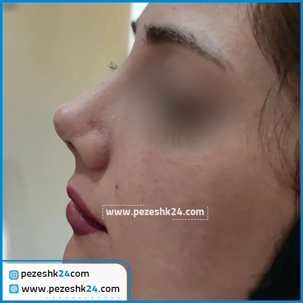 جراحی بینی دکتر مریم کردونی اهواز