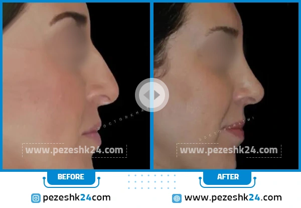 قبل و بعد عمل بینی دکتر ختمی