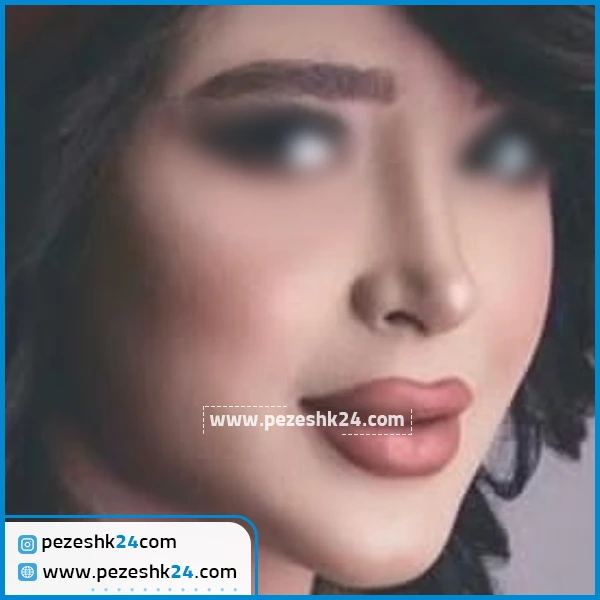 نمونه جراحی بینی دکتر واحدی پور