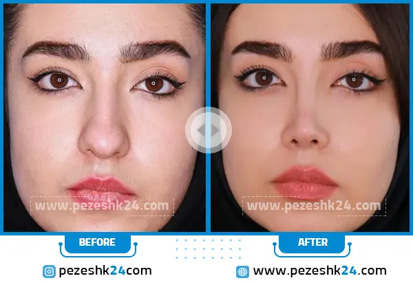 قبل و بعد جراحی بینی دکتر بحری