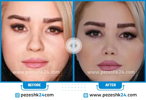 قبل و بعد از عمل بینی دکتر مریم بحری