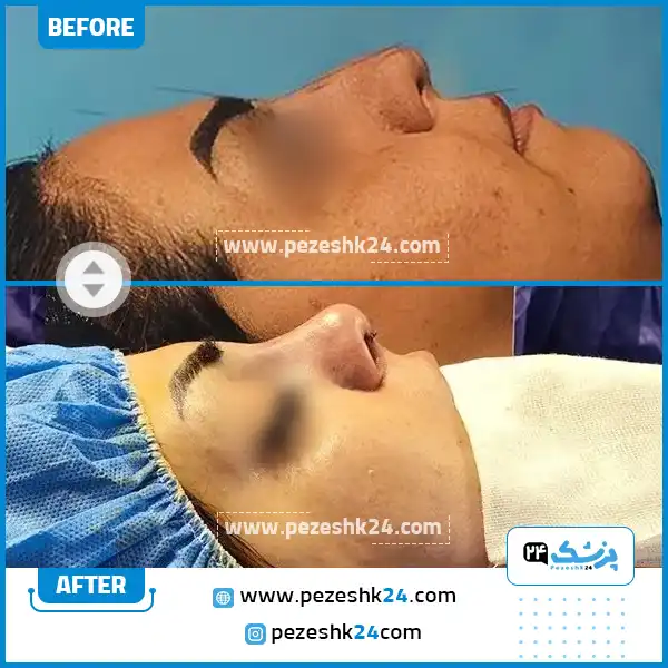 قبل و بعد عمل بینی دکتر قدیری