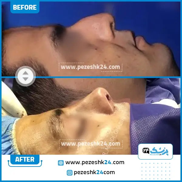 قبل و بعد عمل بینی دکتر قدیری اصفهان