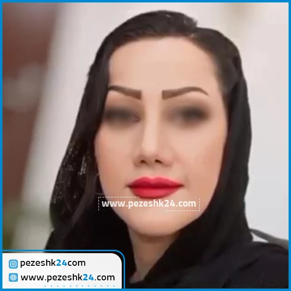 نمونه عمل بینی دکتر فیروزه ضیا