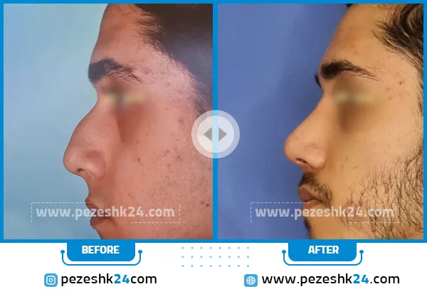 قبل و بعد عمل بینی دکتر فیروزه ضیا