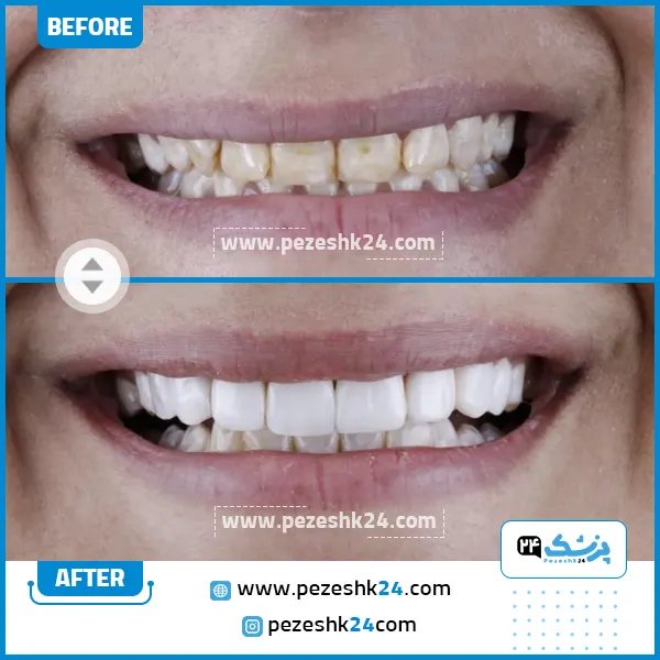 قبل و بعد کامپوزیت دکتر شاهرخی