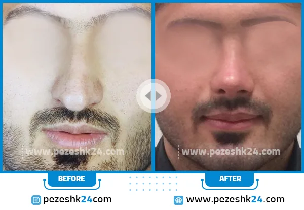 قبل و بعد عمل بینی دکتر لطفی اهواز