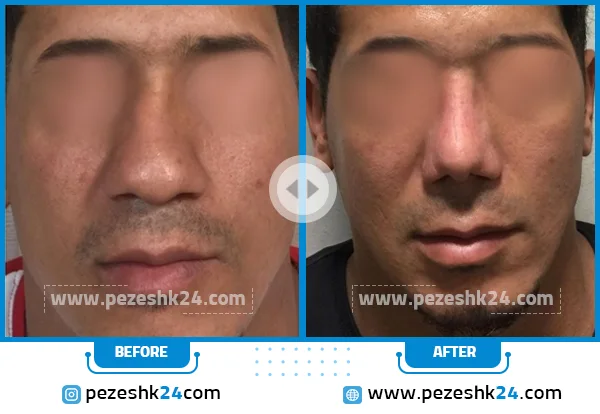 قبل و بعد عمل بینی دکتر لطفی