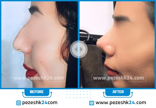 قبل و بعد جراحی بینی دکتر لطفی