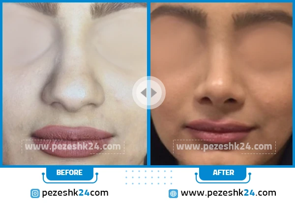 قبل و بعد جراحی بینی دکتر مریم لطفی