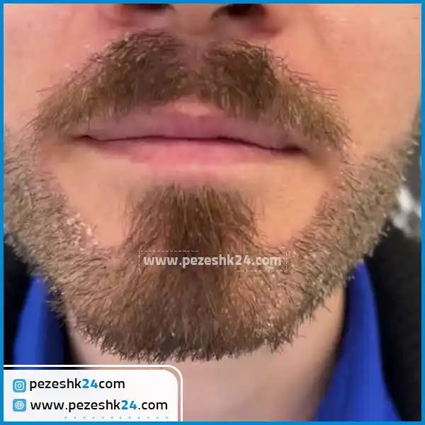 کاشت ریش در مشهد