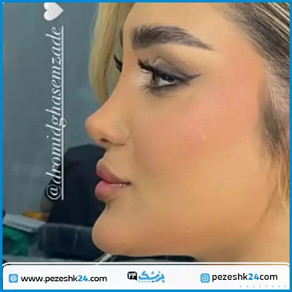 نمونه کار دکتر امید قاسم زاده عمل بینی گوشتی اهواز