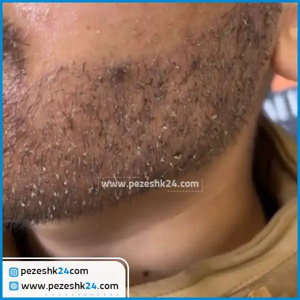 بعد از کاشت ریش