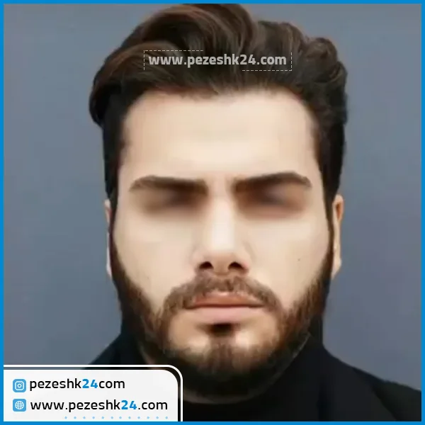 کاشت ریش و سبیل