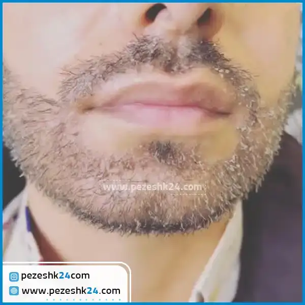 روش کاشت ریش سبیل