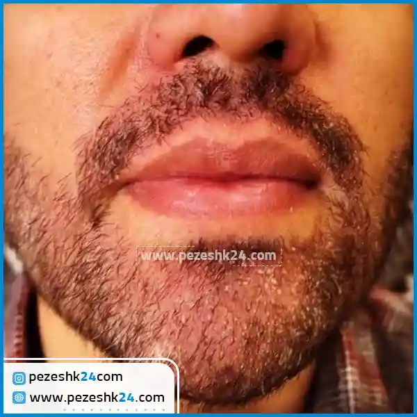 عکس کاشت ریش