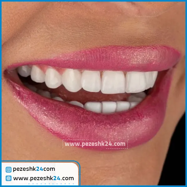 نمونه ایمپلنت دندان دکتر مریم کاردان