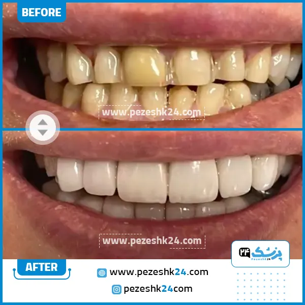 قبل و بعد جراحی لثه دکتر کاردان تهران