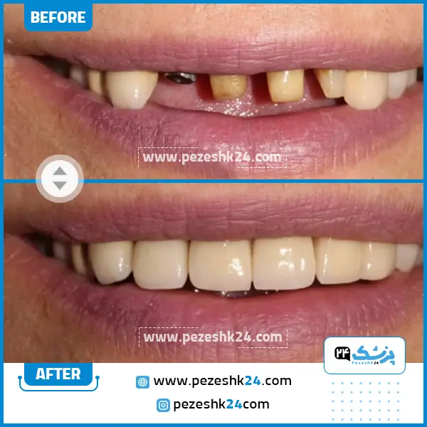 قبل و بعد ایمپلنت دندان دکتر کاردان