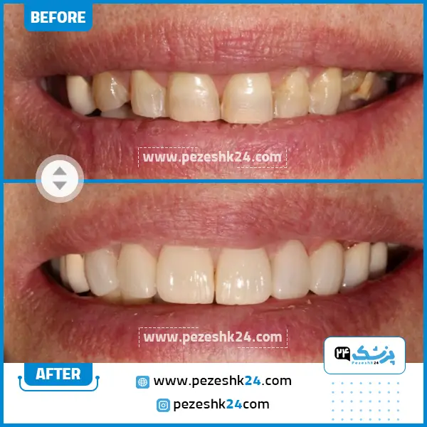 قبل و بعد لیفت لثه دکتر کاردان تهران