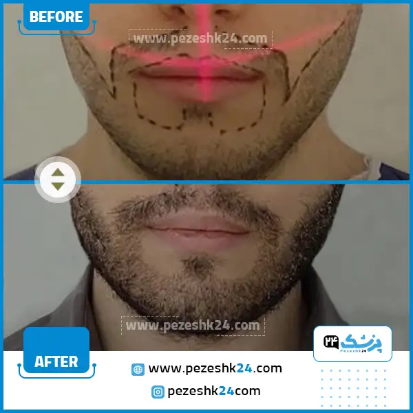 طراحی کاشت ریش سبیل