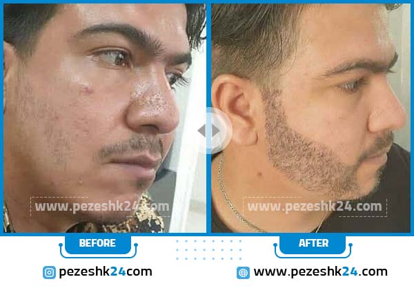 نمونه قبل و بعد کاشت ریش کلینیک تندیس سلامت