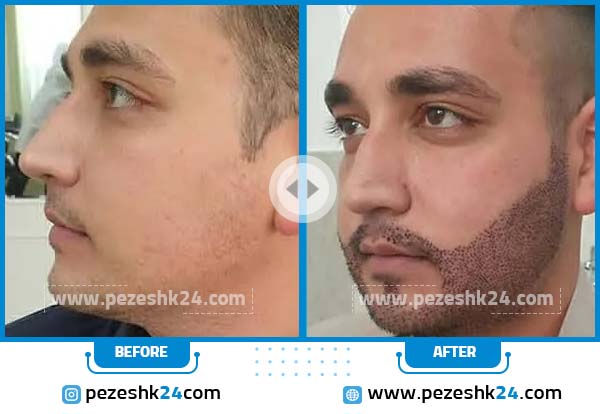 قبل و بعد کاشت ریش کلینیک تندیس سلامت مشهد