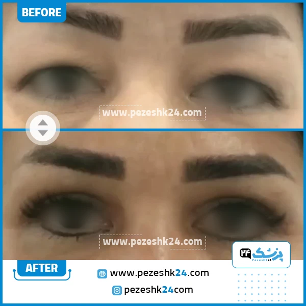 قبل و بعد جراحی پلک دکتر فائقی نیا