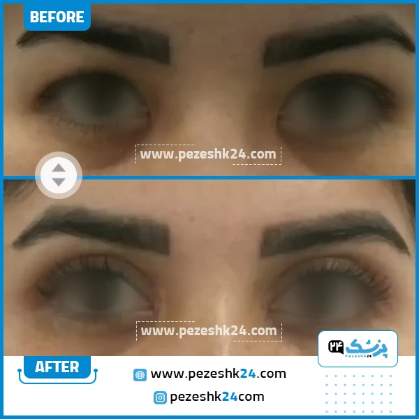 قبل و بعد جراحی پلک دکتر فائقی نیا مشهد