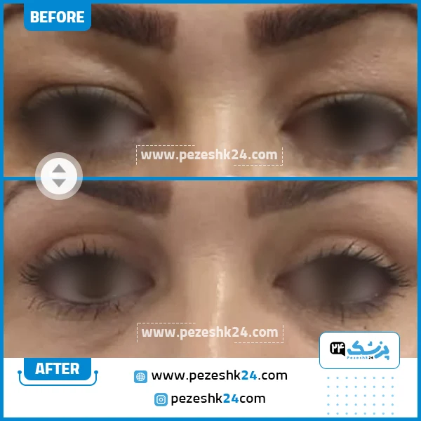 قبل و بعد جراحی پلک دکتر محمد فائقی نیا