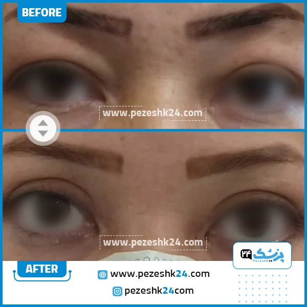 قبل و بعد جراحی بلفاروپلاستی دکتر محمد فائقی نیا