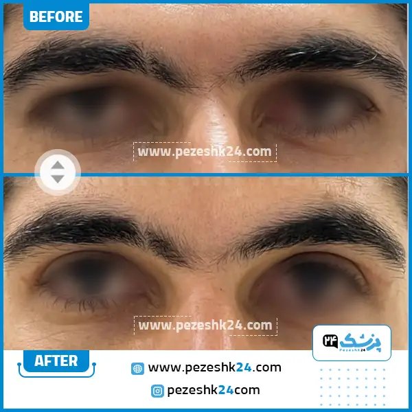قبل و بعد جراحی بلفاروپلاستی دکتر پادرایی