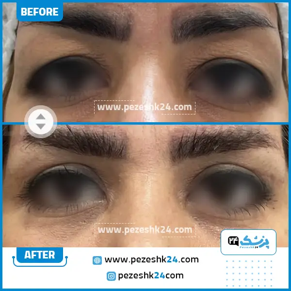 قبل و بعد جراحی بلفاروپلاستی دکتر پادرایی مشهد