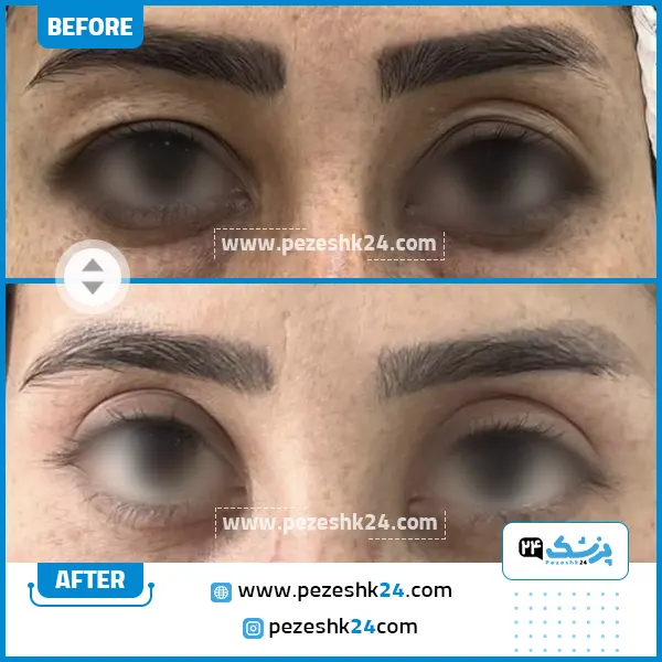 قبل و بعد جراحی بلفاروپلاستی دکتر مریم پادرایی