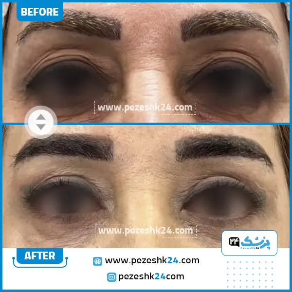 قبل و بعد جراحی بلفاروپلاستی دکتر مریم پادرایی مشهد